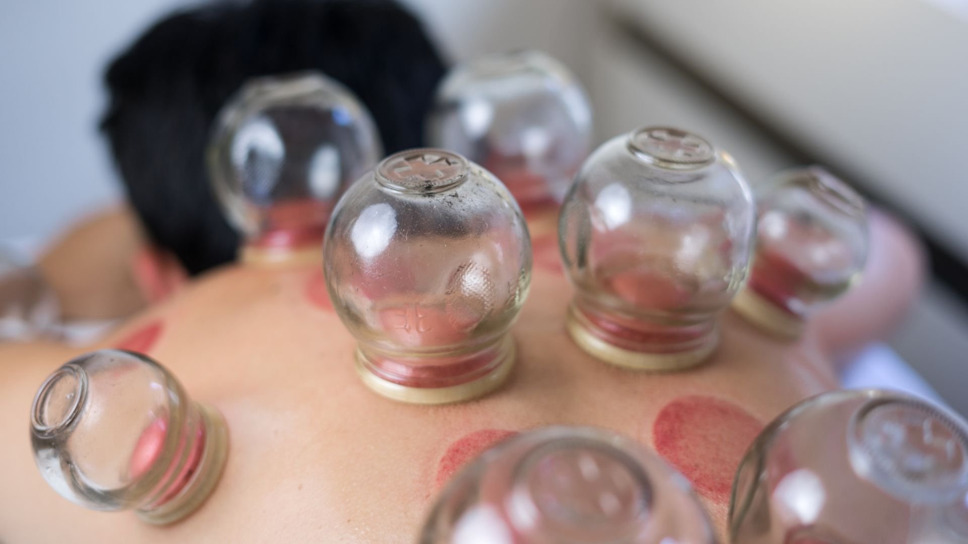 Glass cupping therapy jars on a blurred background